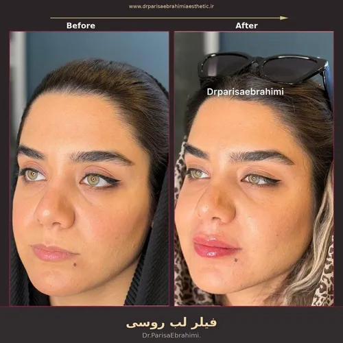 Title: نمونه فیلر لب با تکنیک روسی در کلینیک نیاوران تهران - Description: نمونه فیلر لب با تکنیک روسی در کلینیک نیاوران تهران