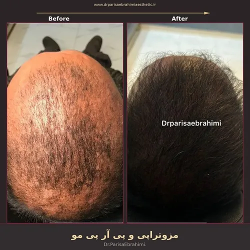 Title: نمونه مزوتراپی مو و PRP در کلینیک دکتر پریسا ابراهیمی تهران - Description: نمونه مزوتراپی مو و PRP در کلینیک دکتر پریسا ابراهیمی تهران
